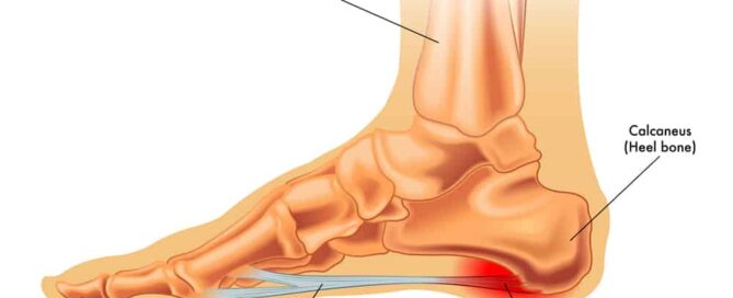 Plantar fasciitis is usually pain at the bottom and inside part of your foot.