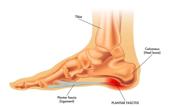 Plantar fasciitis is usually pain at the bottom and inside part of your foot.