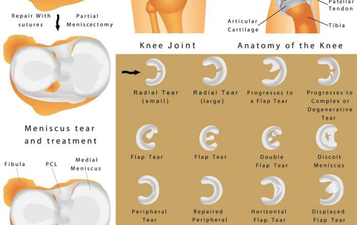 knee meniscal tears symptoms include popping and grinding.
