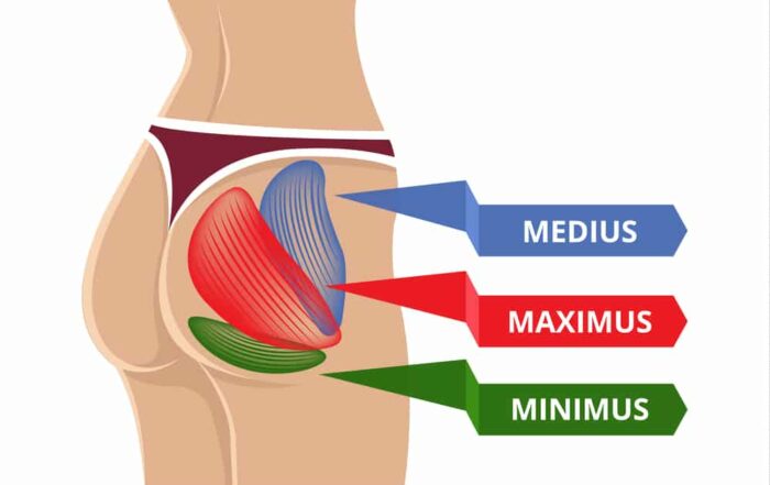 Hip bursitis happens when the bursa gets inflamed around the greater trochanter and glue muscles