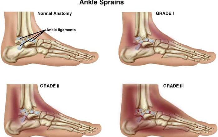 severe ankle sprain, ankle pain