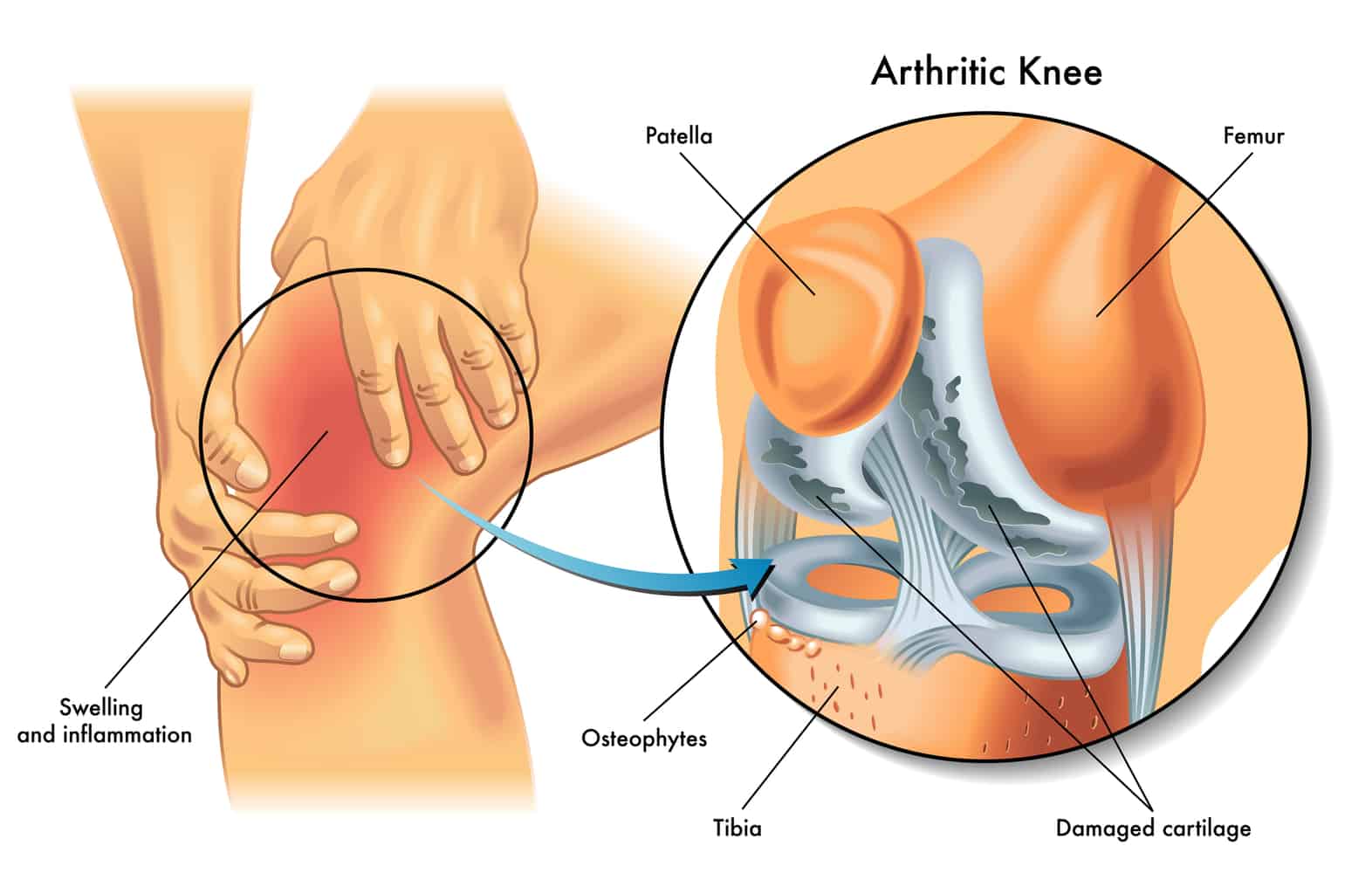 knee pain when walking