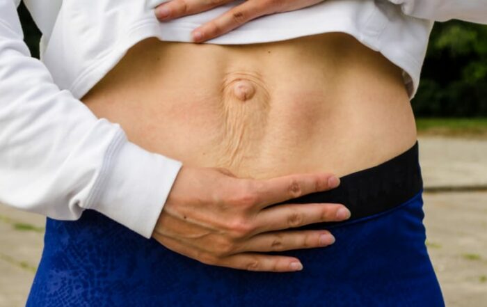 diastasis recti