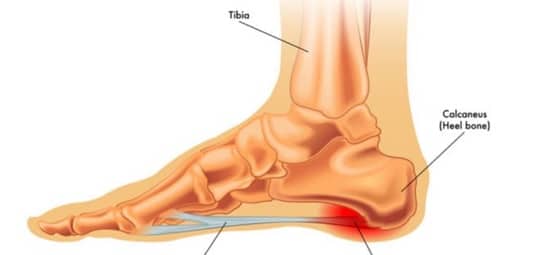 Plantar Fasciitis