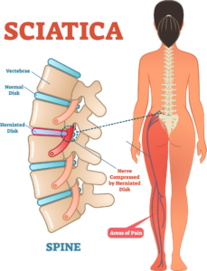 Three Conditions that Mimic Sciatica Pain - Back in Motion