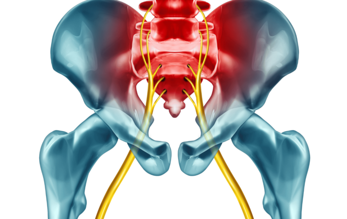 sciatica treatment fort myers