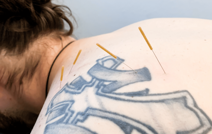 what is dry needling and how it works