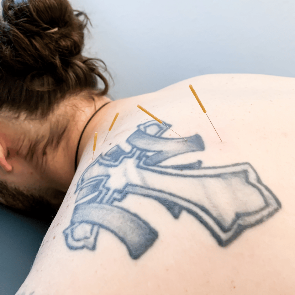 dry needling in fort myers