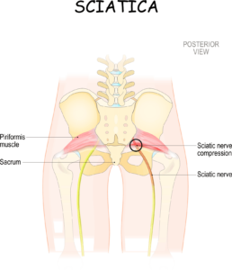 Sciatica