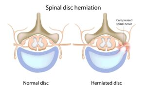 Spinal Disc