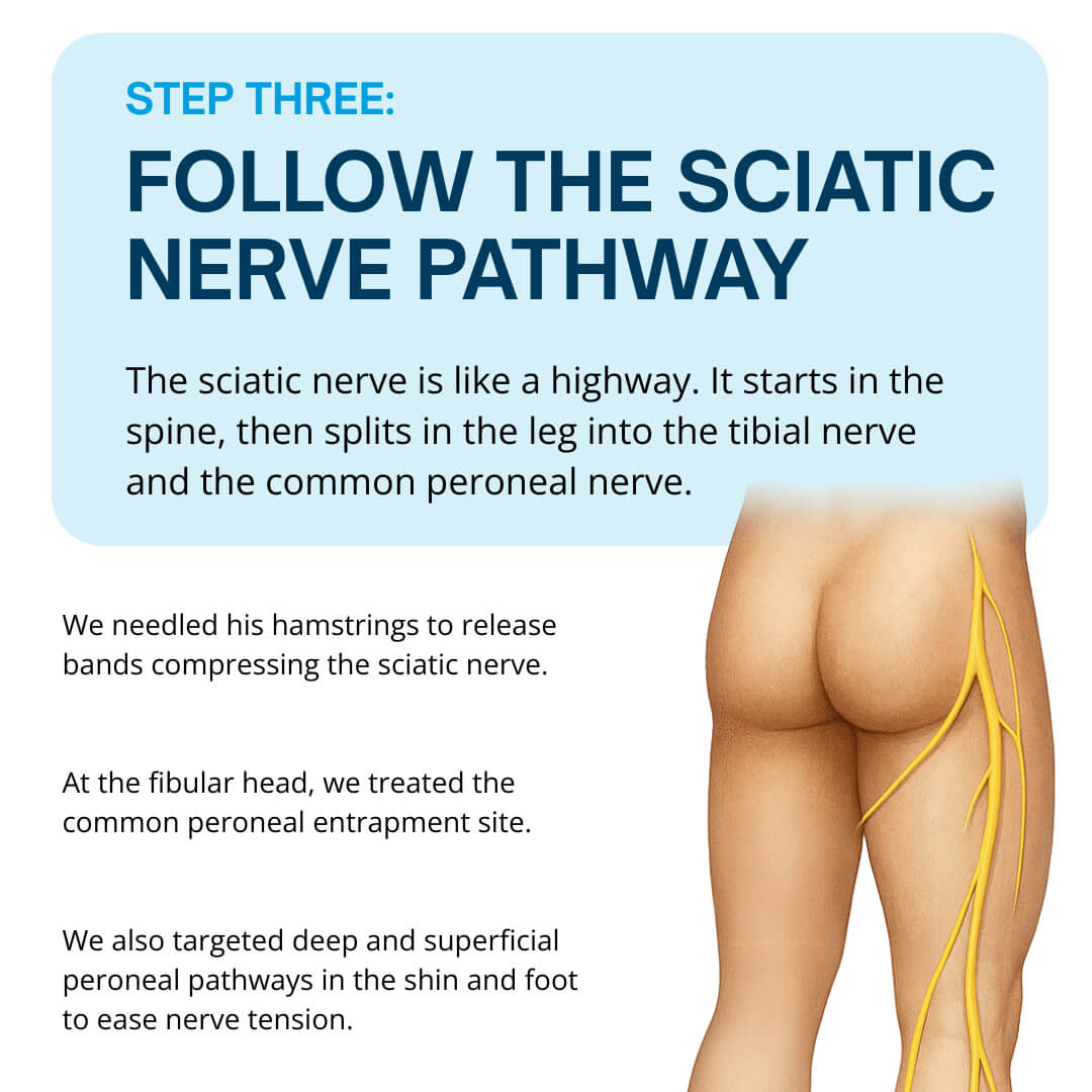 Step Three Follow the Sciatic Nerve Pathway